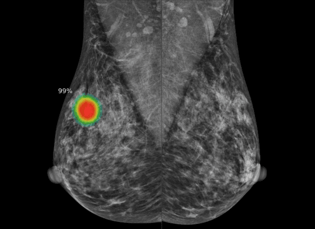 AI로 판독한 유방촬영술